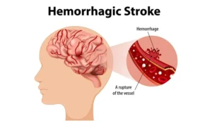 Stroke Hemoragik - Bharata - Solusi Kesehatan Terlengkap